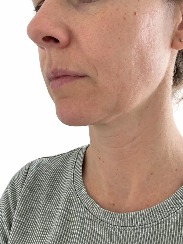 Après · Stella, 42 ans · Double menton · 4 semaines