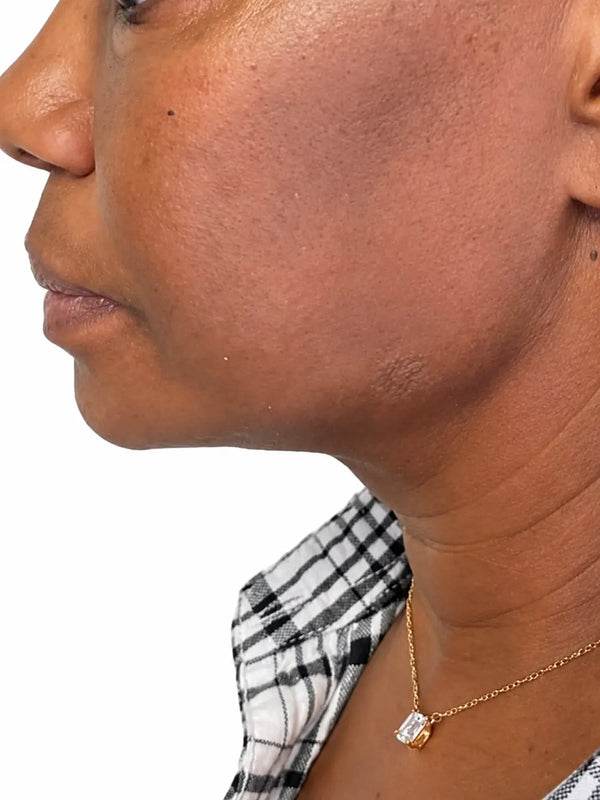 Après · Mireille, 59 ans · Double menton · 5 semaines