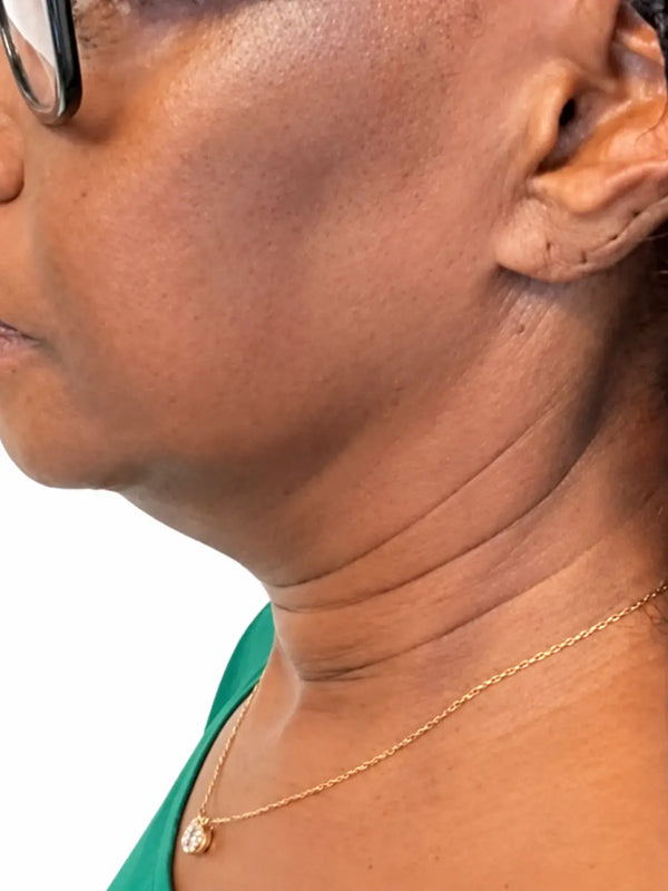 Avant · Mireille, 59 ans · Double menton · 5 semaines