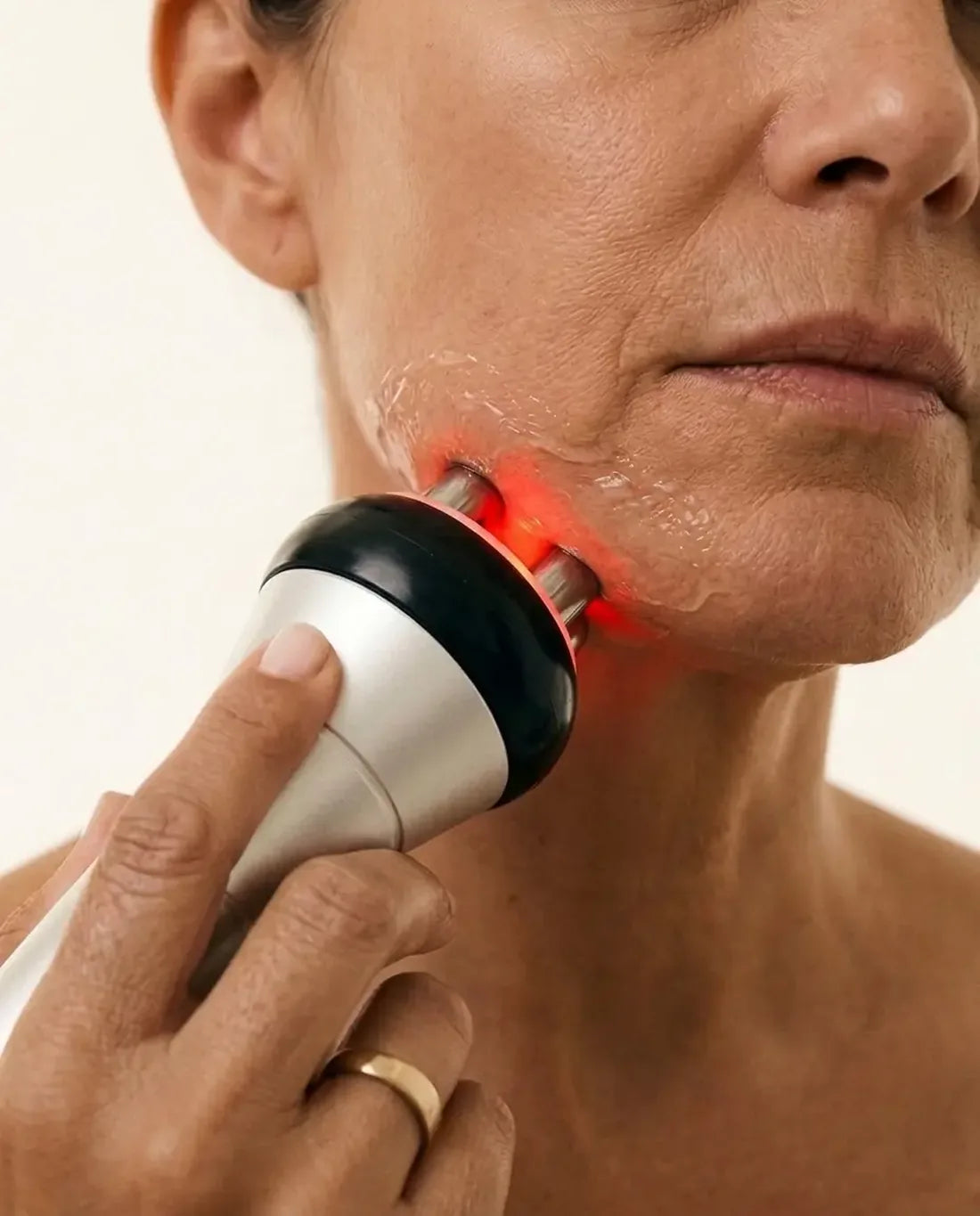 La sonde de radiofréquence NOLYA sur le visage